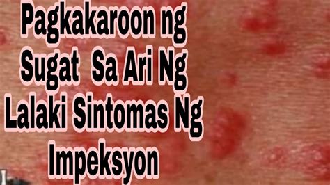 may bolitas|Mga Butlig at Bukol sa Ari: Mga Sintomas ng mga Impeksyong.